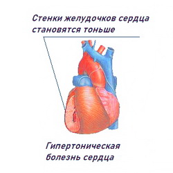 Гипертоническая болезнь сердца